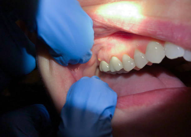 Best Tooth Infection Emergency Dentist  in Riverview, MI